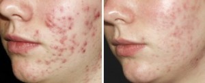 acne puisten laseren