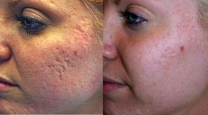 Acne littekens verwijderen Emmeloord